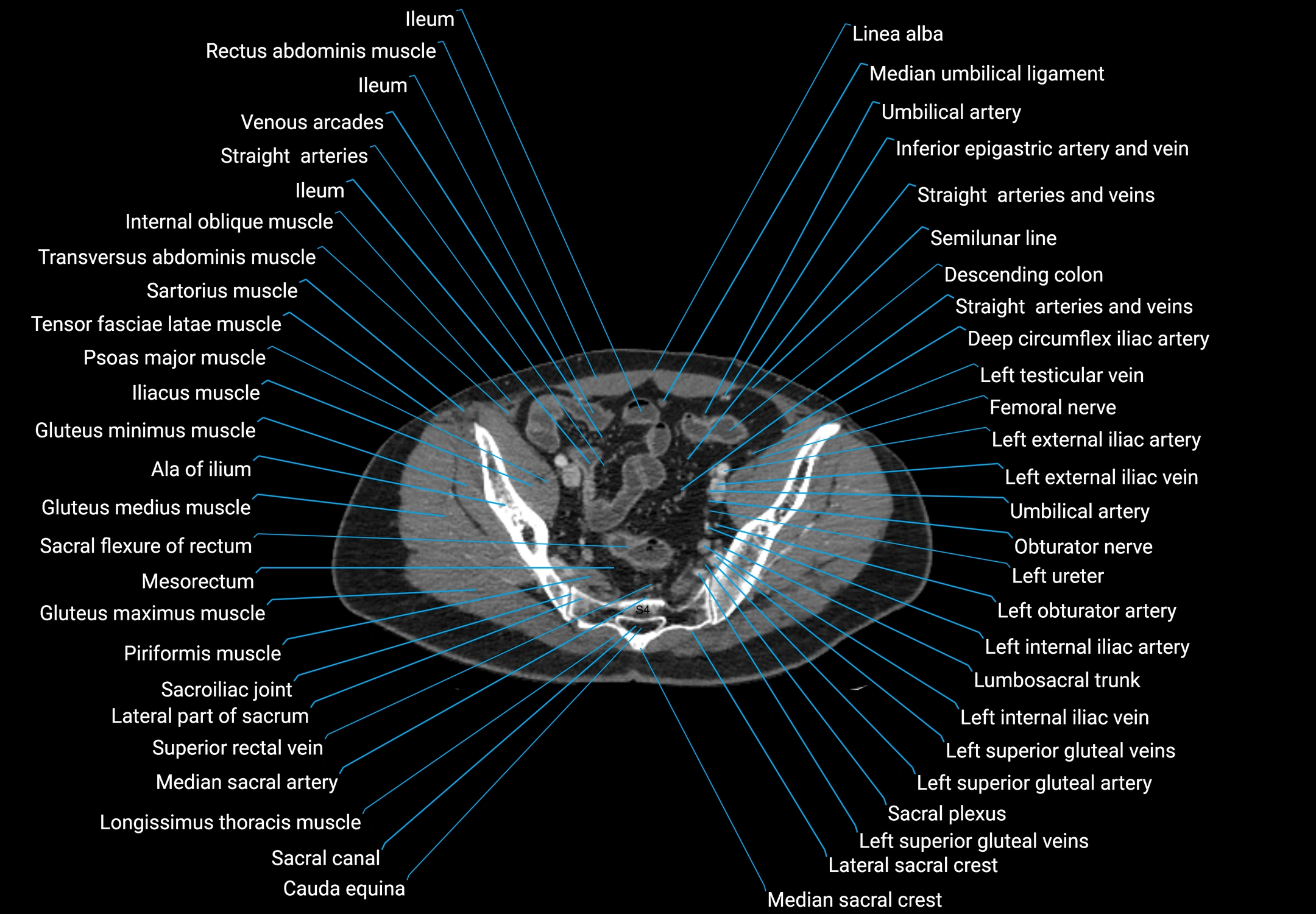 CT male pelvis axial cross sectional anatomy labelled radiology image -00161.webp